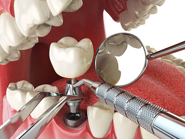 Best Emergency Cosmetic Dentistry (e.g., broken veneers) in Covgton, IN